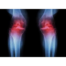 ARTHRITIS AYURVEDA KIT ARTHRITIS AYURVEDA KIT